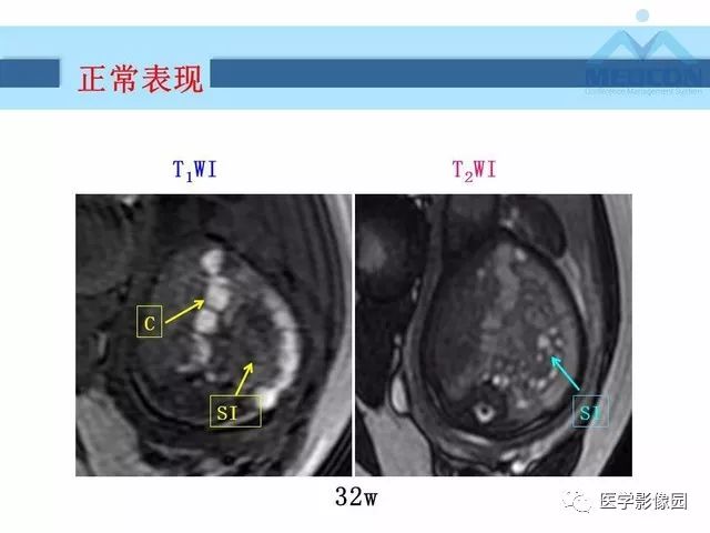 【PPT】胎儿肠梗阻：MRI表现与分析
