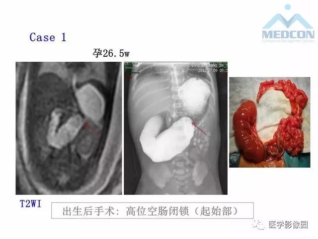 【PPT】胎儿肠梗阻：MRI表现与分析