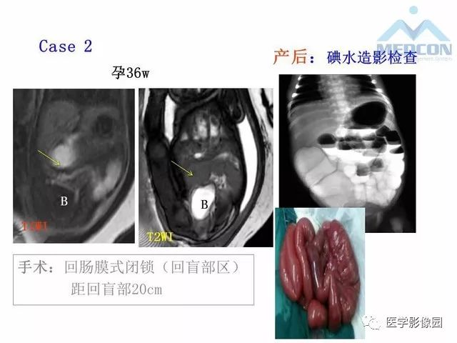 【PPT】胎儿肠梗阻：MRI表现与分析
