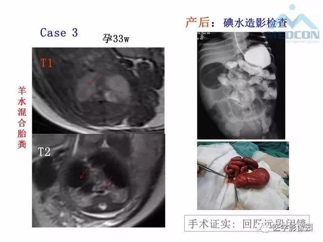【PPT】胎儿肠梗阻：MRI表现与分析