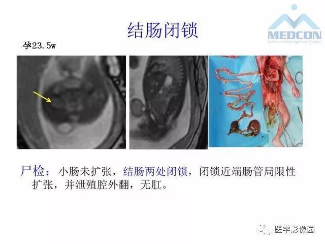 【PPT】胎儿肠梗阻：MRI表现与分析