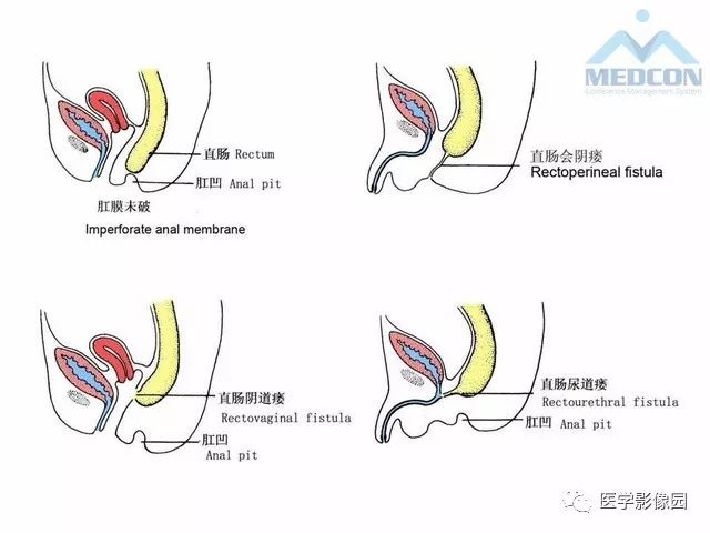【PPT】胎儿肠梗阻：MRI表现与分析