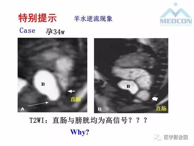 【PPT】胎儿肠梗阻：MRI表现与分析