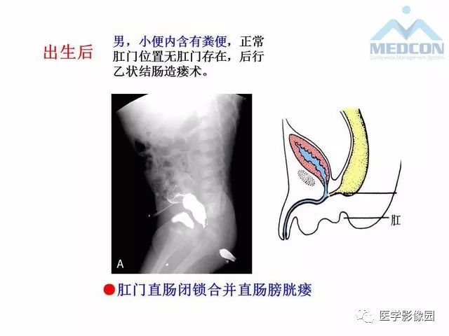 【PPT】胎儿肠梗阻：MRI表现与分析