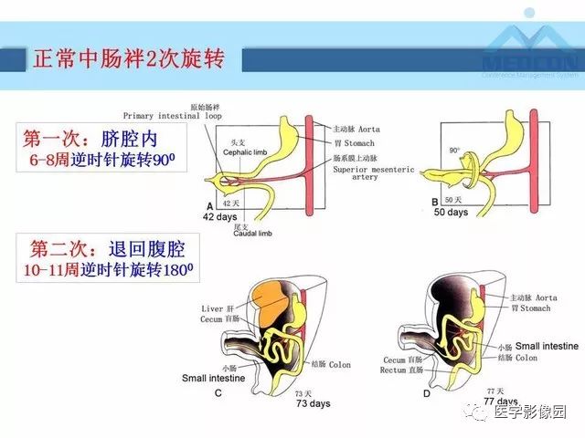 【PPT】胎儿肠梗阻：MRI表现与分析