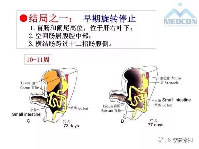 【PPT】胎儿肠梗阻：MRI表现与分析