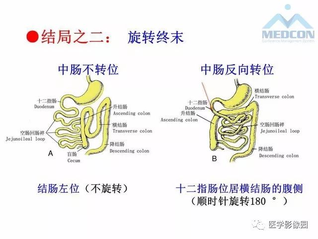 【PPT】胎儿肠梗阻：MRI表现与分析