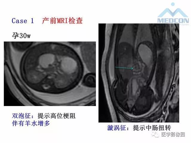【PPT】胎儿肠梗阻：MRI表现与分析