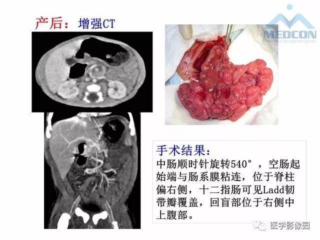 【PPT】胎儿肠梗阻：MRI表现与分析