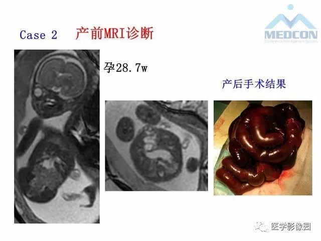 【PPT】胎儿肠梗阻：MRI表现与分析