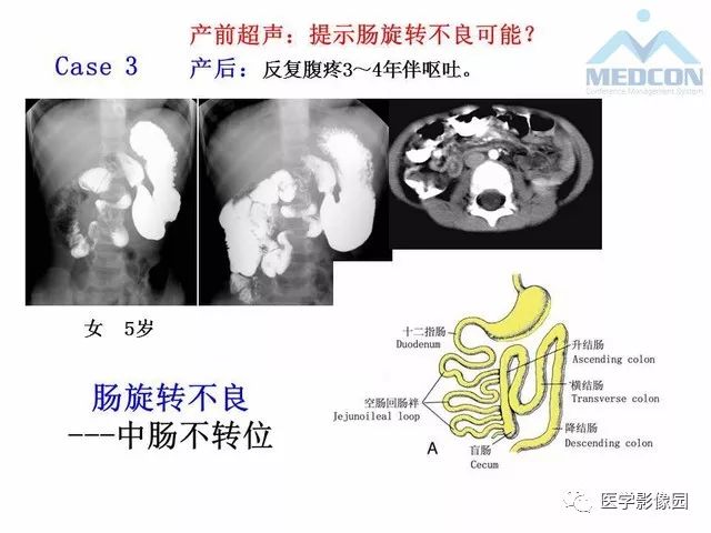 【PPT】胎儿肠梗阻：MRI表现与分析