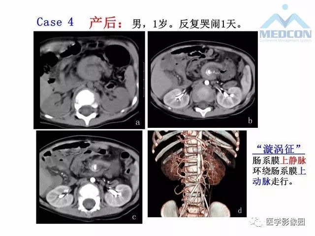 【PPT】胎儿肠梗阻：MRI表现与分析