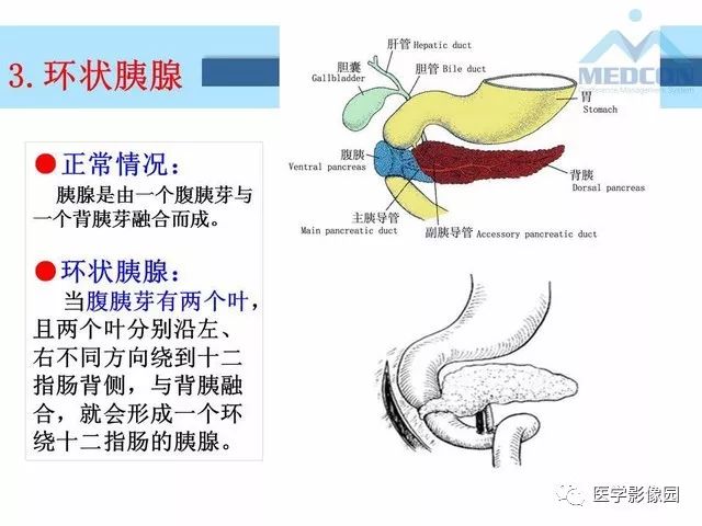 【PPT】胎儿肠梗阻：MRI表现与分析