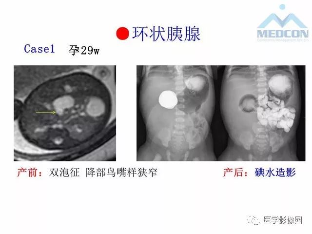 【PPT】胎儿肠梗阻：MRI表现与分析