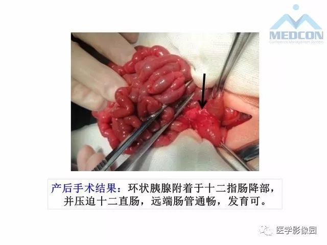 【PPT】胎儿肠梗阻：MRI表现与分析