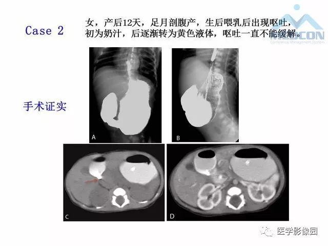 【PPT】胎儿肠梗阻：MRI表现与分析