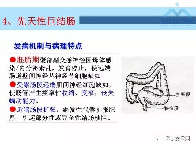 【PPT】胎儿肠梗阻：MRI表现与分析