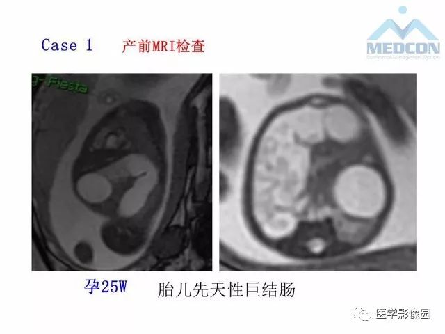 【PPT】胎儿肠梗阻：MRI表现与分析