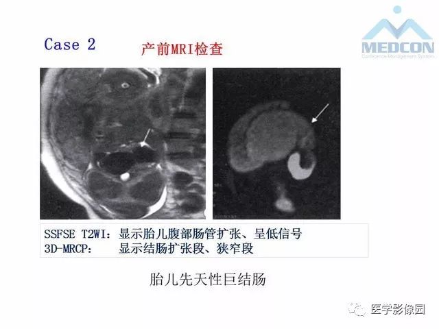 【PPT】胎儿肠梗阻：MRI表现与分析