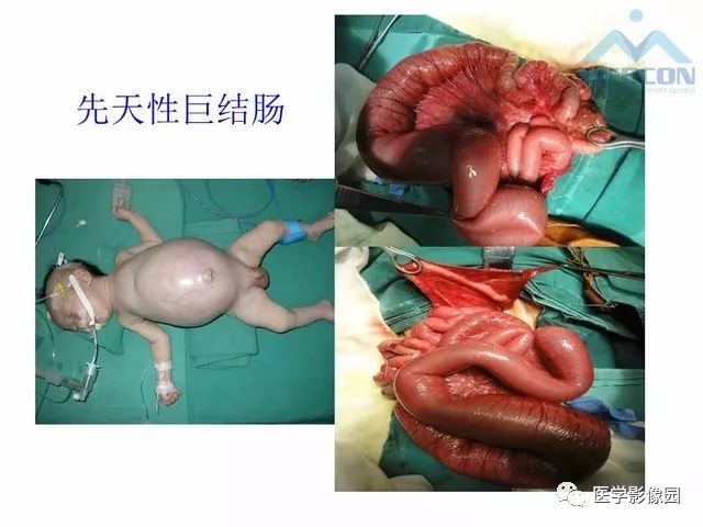 【PPT】胎儿肠梗阻：MRI表现与分析