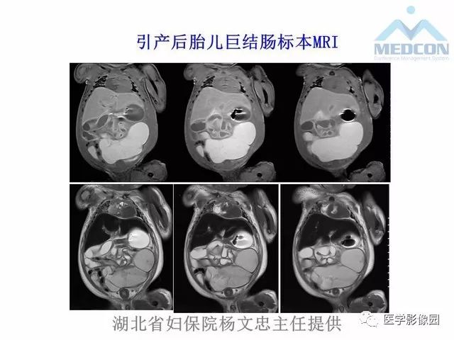 【PPT】胎儿肠梗阻：MRI表现与分析
