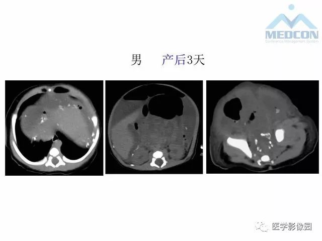 【PPT】胎儿肠梗阻：MRI表现与分析
