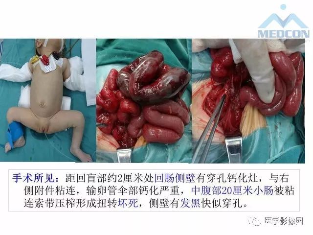 【PPT】胎儿肠梗阻：MRI表现与分析
