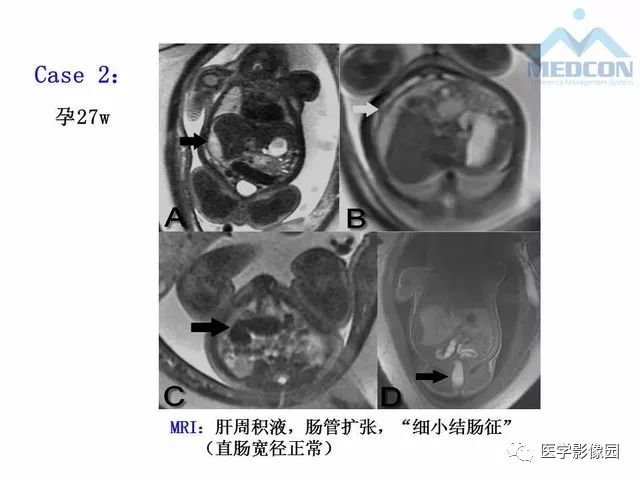 【PPT】胎儿肠梗阻：MRI表现与分析