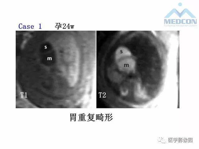 【PPT】胎儿肠梗阻：MRI表现与分析