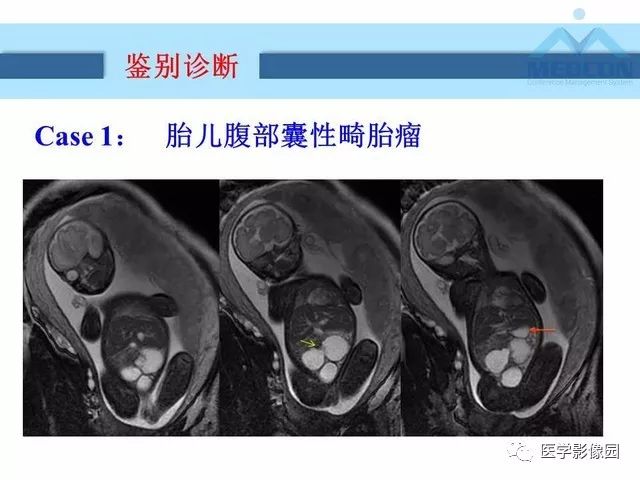 【PPT】胎儿肠梗阻：MRI表现与分析