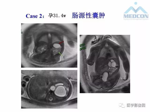【PPT】胎儿肠梗阻：MRI表现与分析