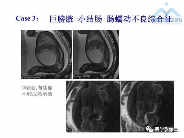 【PPT】胎儿肠梗阻：MRI表现与分析