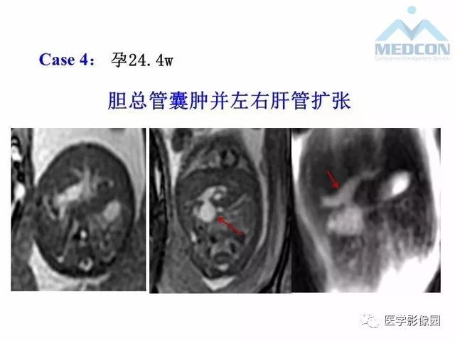 【PPT】胎儿肠梗阻：MRI表现与分析