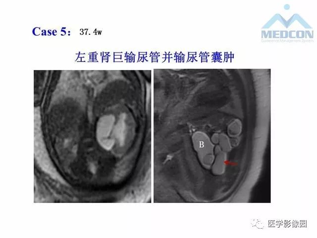 【PPT】胎儿肠梗阻：MRI表现与分析