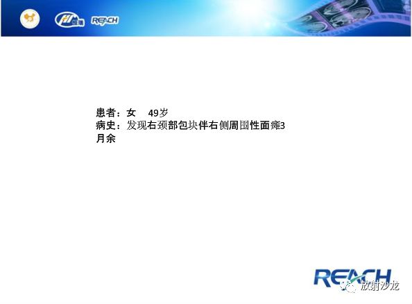 【病例】面神经鞘瘤1例CT及MR影像表现