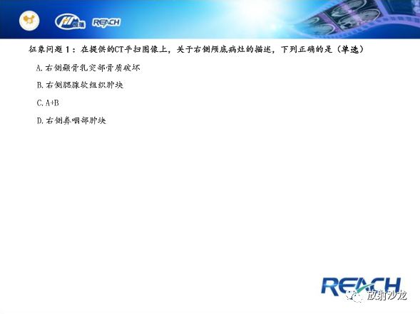 【病例】面神经鞘瘤1例CT及MR影像表现