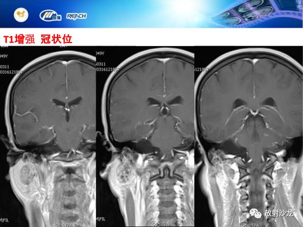 【病例】面神经鞘瘤1例CT及MR影像表现