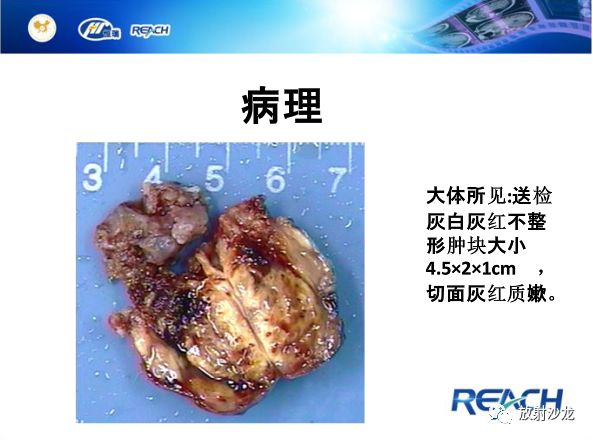 【病例】面神经鞘瘤1例CT及MR影像表现