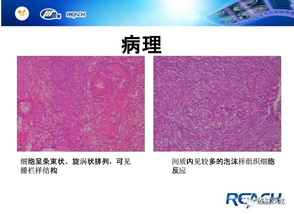 【病例】面神经鞘瘤1例CT及MR影像表现