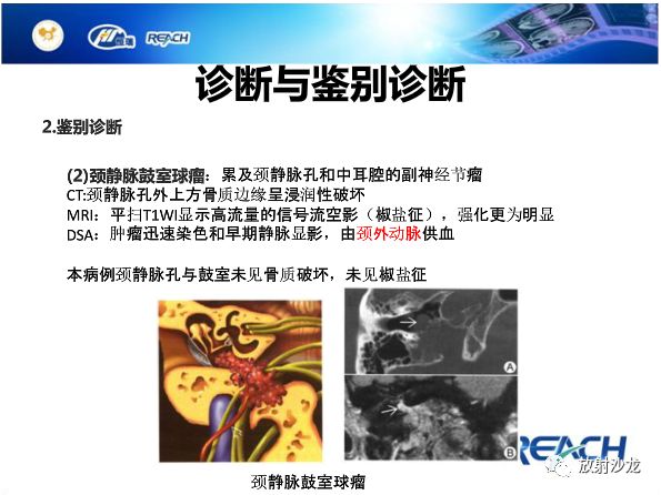 【病例】面神经鞘瘤1例CT及MR影像表现