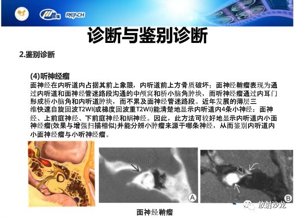 【病例】面神经鞘瘤1例CT及MR影像表现