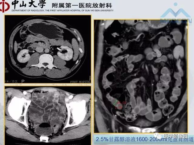 【PPT】胃肠胰神经内分泌肿瘤的病理与治疗后影像观察