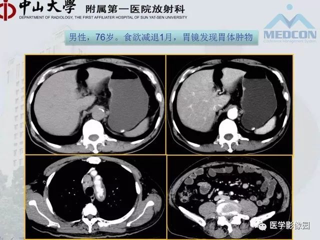 【PPT】胃肠胰神经内分泌肿瘤的病理与治疗后影像观察