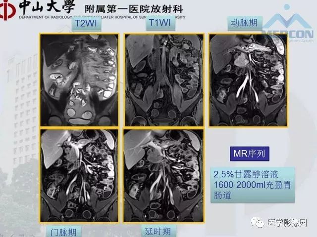 【PPT】胃肠胰神经内分泌肿瘤的病理与治疗后影像观察