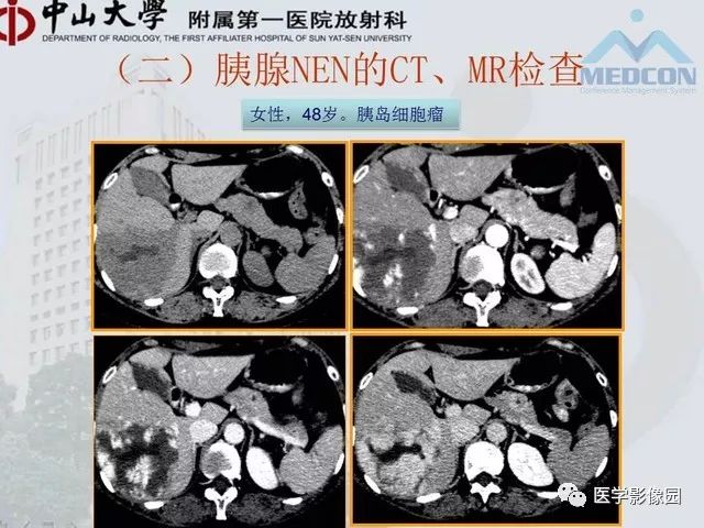 【PPT】胃肠胰神经内分泌肿瘤的病理与治疗后影像观察