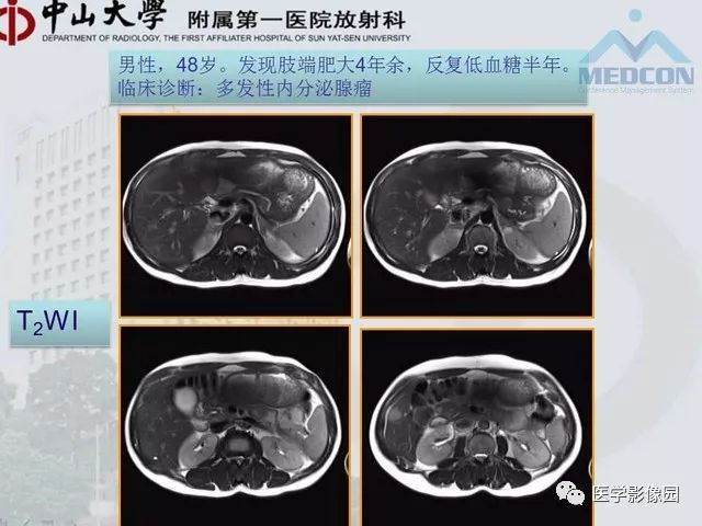 【PPT】胃肠胰神经内分泌肿瘤的病理与治疗后影像观察