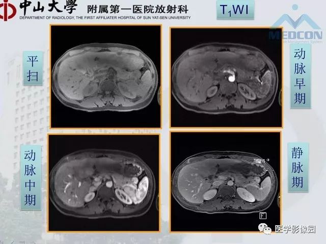 【PPT】胃肠胰神经内分泌肿瘤的病理与治疗后影像观察
