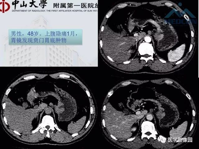 【PPT】胃肠胰神经内分泌肿瘤的病理与治疗后影像观察