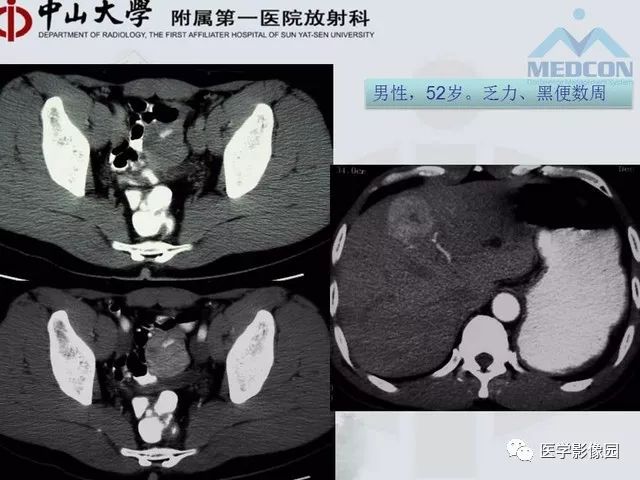【PPT】胃肠胰神经内分泌肿瘤的病理与治疗后影像观察