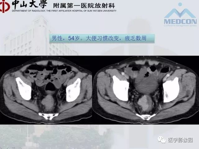 【PPT】胃肠胰神经内分泌肿瘤的病理与治疗后影像观察